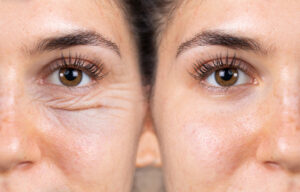Les yeux comme miroir de l’âme : comment la blépharoplastie peut vous aider à paraître plus jeune et plus dynamique.